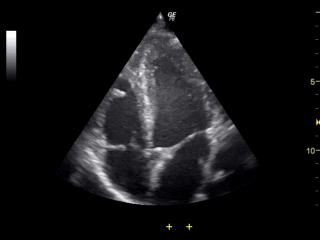 Ultrasound_of_human_heart_apical_4-cahmber_view